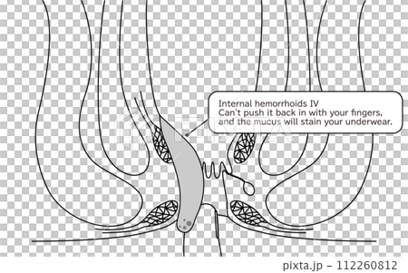 肛門の病気、痔・いぼ痔「内痔核Ⅳ度」　図解イラスト、断面図 112260812