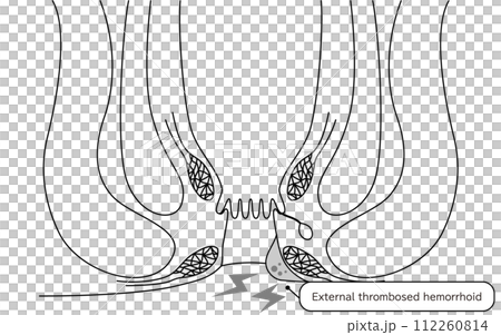 肛門の病気、痔・いぼ痔「血栓性外痔核」　図解イラスト、断面図 112260814
