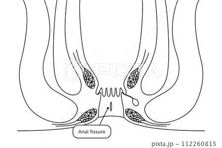 肛門の病気、痔「切れ痔(裂肛)」 図解イラスト、断面図 肛門の病気、痔「切れ痔(裂肛)」 図解イラスト、断面図 112260815