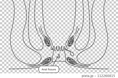 肛門の病気、痔「切れ痔(裂肛)」 図解イラスト、断面図 肛門の病気、痔「切れ痔(裂肛)」 図解イラスト、断面図 112260815