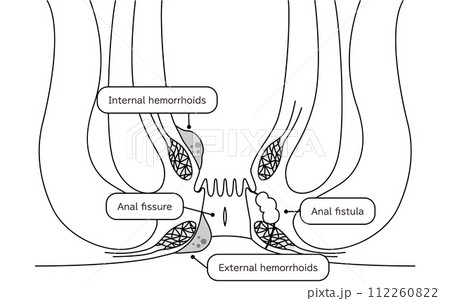 肛門の病気、痔・いぼ痔・切れ痔・あな痔　図解イラスト、断面図 112260822