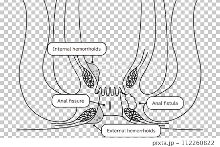 肛門の病気、痔・いぼ痔・切れ痔・あな痔　図解イラスト、断面図 112260822