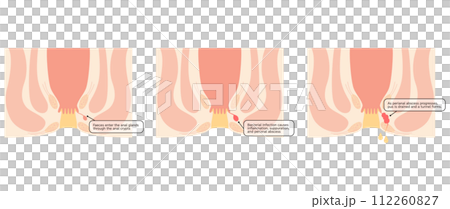 Anal disease, hemorrhoids "Anal hemorrhoids" Illustrated illustration, cross-sectional view Anal disease, hemorrhoids "Anal hemorrhoids" Illustrated illustration, cross-sectional view 112260827