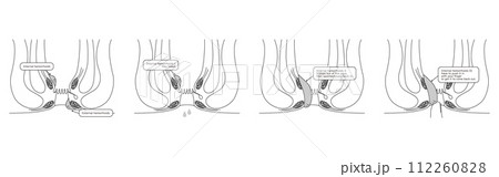 肛門の病気、痔・いぼ痔「内痔核Ⅰ～Ⅳ度」　図解イラスト、断面図 112260828