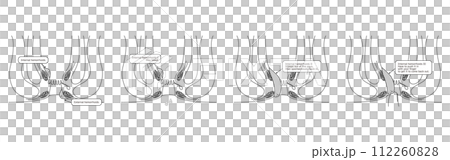 肛門の病気、痔・いぼ痔「内痔核Ⅰ～Ⅳ度」　図解イラスト、断面図 112260828