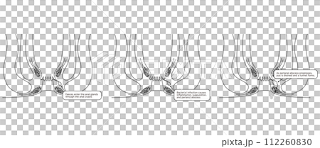 Anal disease, hemorrhoids "Anal hemorrhoids" Illustrated illustration, cross-sectional view 112260830