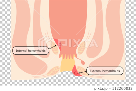 Anal disease, hemorrhoids/wart hemorrhoids illustrated illustrations, cross-sectional view 112260832