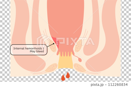 Anal disease, hemorrhoids/wart hemorrhoids "internal hemorrhoids grade I" Illustrated illustration, cross-sectional view 112260834