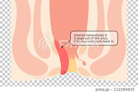 肛門疾病、痔瘡/疣痔「II 級內痔」插圖，橫斷面圖 112260835