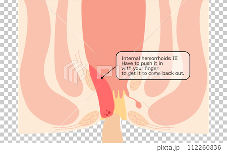 肛門疾病、痔瘡/疣痔「內痔 III 級」插圖，橫斷面圖 112260836