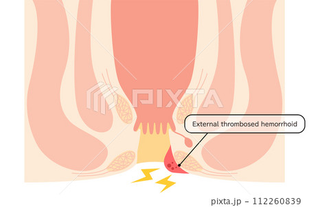 肛門の病気、痔・いぼ痔「血栓性外痔核」 図解イラスト、断面図 肛門の病気、痔・いぼ痔「血栓性外痔核」 図解イラスト、断面図 112260839