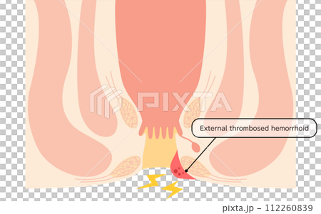肛門の病気、痔・いぼ痔「血栓性外痔核」 図解イラスト、断面図 肛門の病気、痔・いぼ痔「血栓性外痔核」 図解イラスト、断面図 112260839