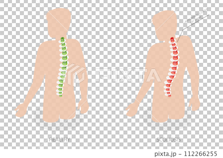3D Isometric Flat Conceptual Illustration of Scoliosis, Normal Spine and One with Defects 3D Isometric Flat Conceptual Illustration of Scoliosis, Normal Spine and One with Defects 112266255