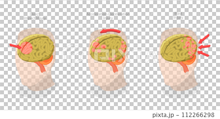 3D Isometric Flat  Conceptual Illustration of Brain Injuries, Head Trauma Scheme 112266298