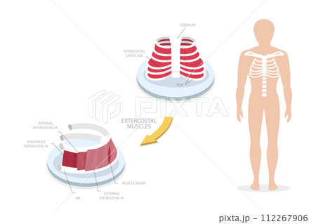 3D Isometric Flat Conceptual Illustration of Intercostal Muscle Strain, Human Anatomy 3D Isometric Flat Conceptual Illustration of Intercostal Muscle Strain, Human Anatomy 112267906
