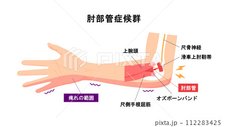 肘部管症候群の原因とメカニズム ベクターイラスト 112283425