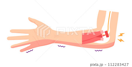 肘部管症候群の原因とメカニズム ベクターイラスト(文字なし) 112283427