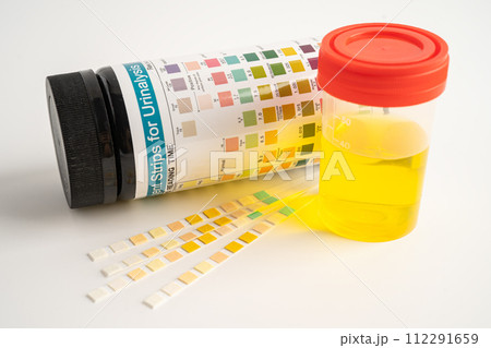 Urinalysis, urine cup with reagent strip pH paper test and comparison chart in laboratory. Urinalysis, urine cup with reagent strip pH paper test and comparison chart in laboratory. 112291659