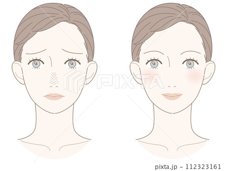 毛穴の開き　いちご鼻　改善　女性　イラスト 112323161