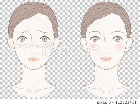 そばかす 改善 女性 イラスト そばかす 改善 女性 イラスト 112323411