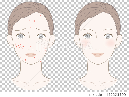 赤ニキビ 改善 女性 イラスト 赤ニキビ 改善 女性 イラスト 112323590