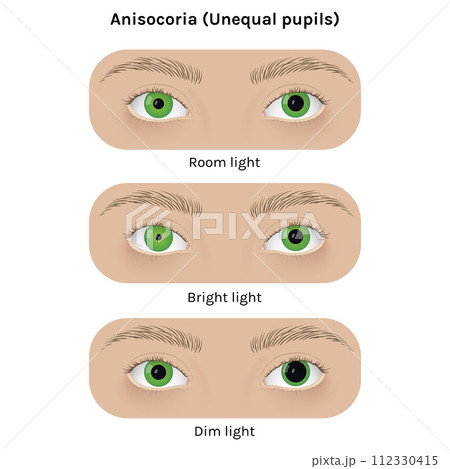 Realistic human eyes with anisocoria vector illustration design. Unequal pupil, anatomy, health. 112330415