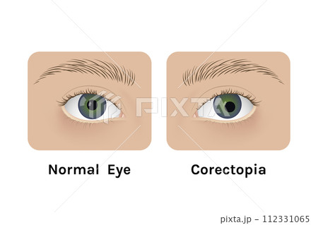 Realistic human normal eyes and with corectopia...のイラスト素材 [112331065 ...