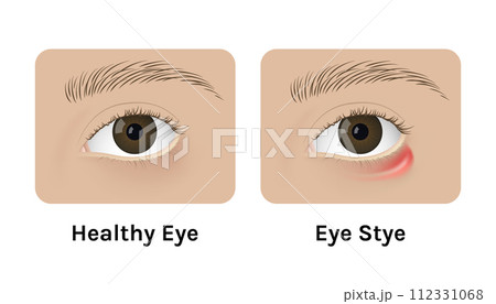Realistic human healthy eye and with stye vector illustration design. Red inflammation, anatomy, health. Realistic human healthy eye and with stye vector illustration design. Red inflammation, anatomy, health. 112331068