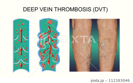 Deep Vein Thrombosis or Blood Clots. Embolus. Deep Vein Thrombosis or Blood Clots. Embolus. 112383046