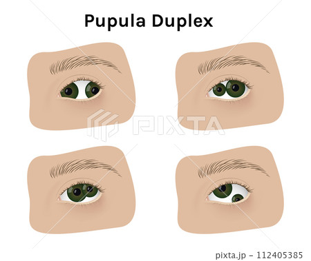 Realistic human eyes with pupula duplex vector illustration design. Human mutation, anatomy, health. 112405385