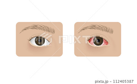 Realistic human healthy eye and with conjunctivitis vector illustration design. Red dry eye syndrome, anatomy, health and allergies. 112405387