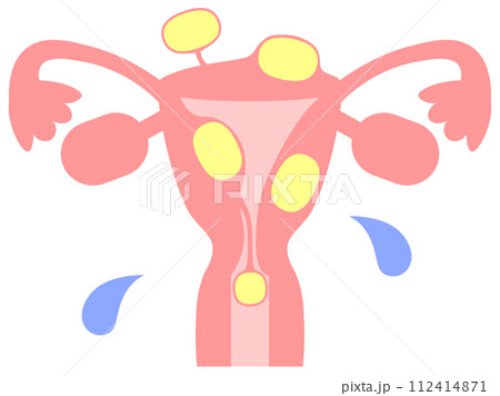 子宮筋腫の種類をシンプルでやさしいタッチで描いたイメージ図 子宮筋腫の種類をシンプルでやさしいタッチで描いたイメージ図 112414871
