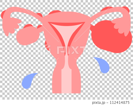 子宮内膜症のできやすい箇所をシンプルでフラットなタッチで描いたイメージ図 112414875