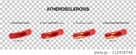 Medical illustration of blood vessel flow and arteriosclerosis 112416748