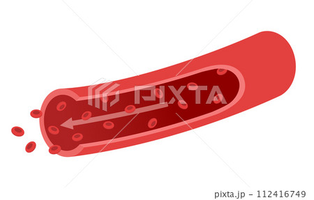 血管の流れと赤血球の説明図　医療イラスト 112416749