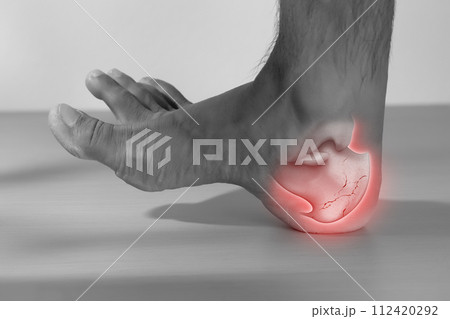 A man has a heel bone is broken. 112420292