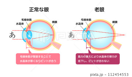 正常な眼と老眼 比較ベクターイラスト 112454553