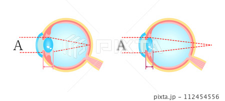 正常な眼と老眼 比較ベクターイラスト 正常な眼と老眼 比較ベクターイラスト 112454556