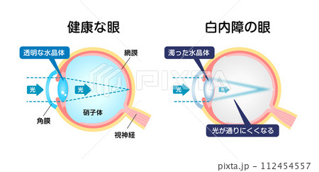健康な眼と白内障の眼の比較 ベクターイラスト 健康な眼と白内障の眼の比較 ベクターイラスト 112454557