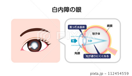 白内障の眼 構造と原因 ベクターイラスト 112454559