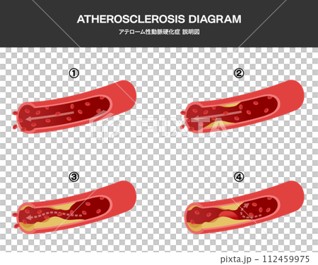 Medical illustration of blood vessel flow and arteriosclerosis Medical illustration of blood vessel flow and arteriosclerosis 112459975