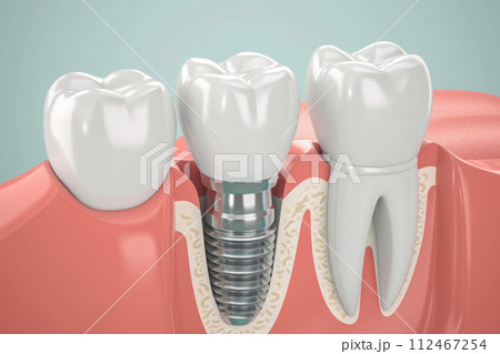 Tooth implant installed in jaw. Dental surgery 112467254