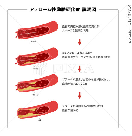 血管の流れと動脈硬化の説明図 医療イラスト 血管の流れと動脈硬化の説明図 医療イラスト 112487814
