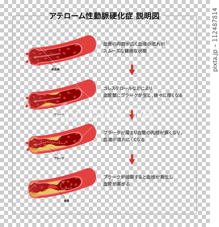 Medical illustration of blood vessel flow and arteriosclerosis Medical illustration of blood vessel flow and arteriosclerosis 112487814
