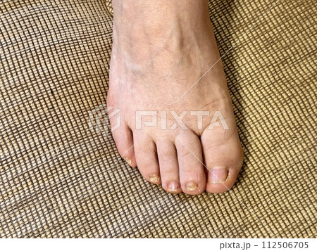 Fungus Onycholysis infection of on nails of woman's toenail fungus. Close-up. 112506705