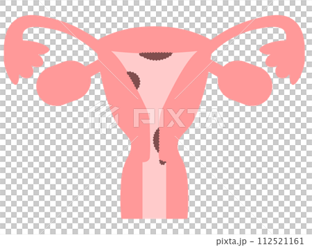 輕輕觸摸描繪子宮癌類型的圖像圖 112521161