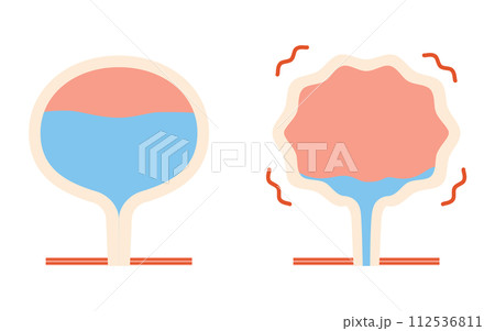 過活動膀胱の医療イラスト、正常な膀胱と過活動膀胱の比較 112536811