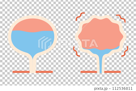 過活動膀胱の医療イラスト、正常な膀胱と過活動膀胱の比較 112536811