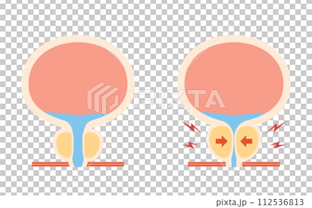 前立腺肥大症の医療イラスト、正常な前立腺と肥大した前立腺の比較 112536813