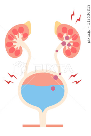 腎盂腎炎の医療イラスト、細菌が膀胱から腎臓に逆流する流れ 腎盂腎炎の医療イラスト、細菌が膀胱から腎臓に逆流する流れ 112536815